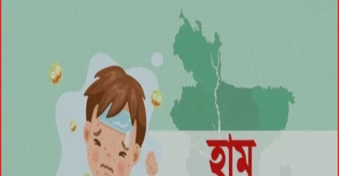 দেশে হামের উপসর্গে আরও ৪ জনের মৃত্যু