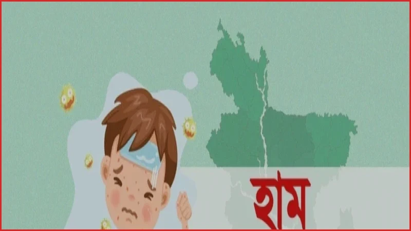 দেশে হামের উপসর্গে আরও ৪ জনের মৃত্যু