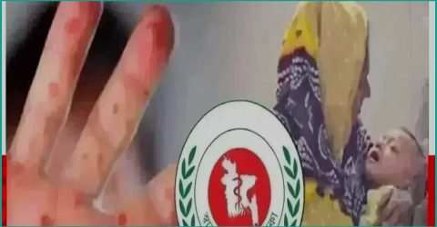 হামের উপসর্গে আরও সাতজনের মৃত্যু, মোট মৃত্যু হাজার ছাড়াল
