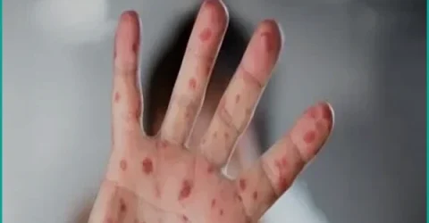 হামের উপসর্গে ২৪ ঘণ্টায় আরও ৫ জনের মৃত্যু